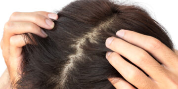 5 Signs That Your Hair Needs Regrowth Treatment