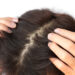 5 Signs That Your Hair Needs Regrowth Treatment