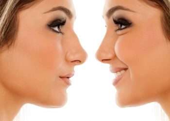 What You Need to Know About Rhinoplasty