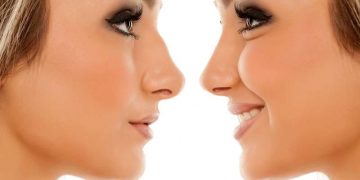 What You Need to Know About Rhinoplasty