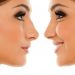 What You Need to Know About Rhinoplasty