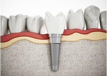 Are Dental Implants Painful? 5 Common Questions About Dental Implants