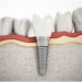 Are Dental Implants Painful? 5 Common Questions About Dental Implants