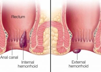 8 Tips to Prevent Piles