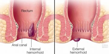 8 Tips to Prevent Piles