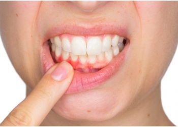 Keeping Your Teeth Healthy: 5 Important Tips