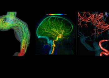 What is Pulsatile Tinnitus?