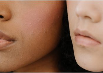 Severe Acne: Symptoms & Treatment Medications