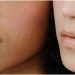 Severe Acne: Symptoms & Treatment Medications