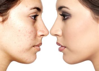 4 Types of Blemishes and How to Stop Them