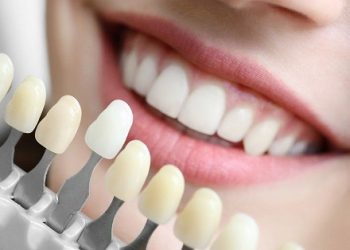 The Benefits of Dental Implants Explained