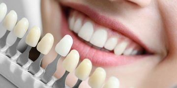 The Benefits of Dental Implants Explained