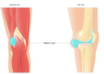 What Is Baker’s Cyst? Symptoms and Causes of Baker’s Cyst