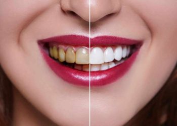 Should you get tooth veneers if you have damaged teeth?