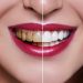 Should you get tooth veneers if you have damaged teeth?