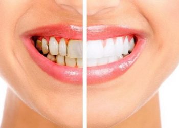 At Home Teeth Whitening That Works