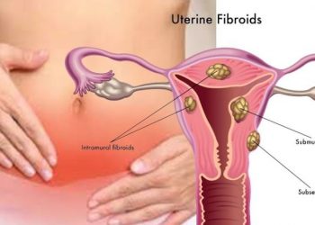 Uterine Fibroids: Top 4 Dos and Don’ts