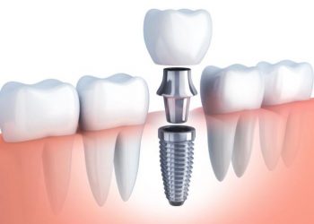 Tips to Prepare for Your Tooth Implant