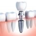 Tips to Prepare for Your Tooth Implant