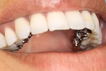  What is Invisalign, and what is the cost of using it?