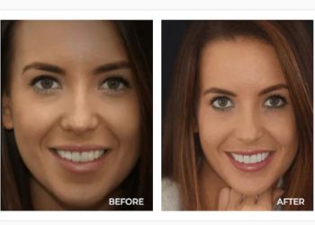 Why Does Porcelain Veneer Require an Expert Cosmetic Dentist?