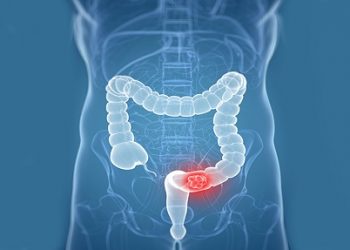 A Guide to Diagnosing and Treating Colon Cancer