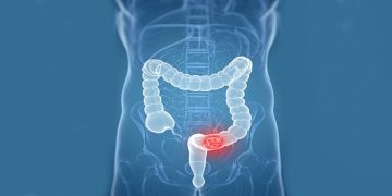 A Guide to Diagnosing and Treating Colon Cancer