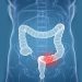 A Guide to Diagnosing and Treating Colon Cancer