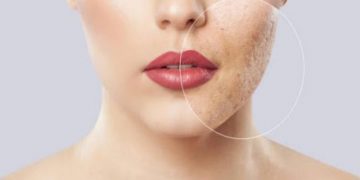 Acne Care – 6 Formulations Dermatologists Recommend to Fight Acne