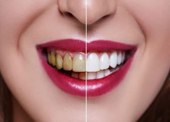 Teeth Straightening: A Highly Beneficial Treatment 