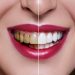Teeth Straightening: A Highly Beneficial Treatment 