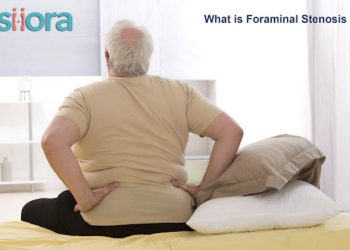 What is Foraminal Stenosis?