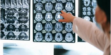 How Can Online Neurologists Help With Memory Loss?