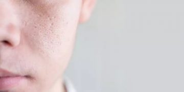 How to make skin blemishes less visible.