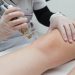 Permanent Leg Hair Removal in Singapore