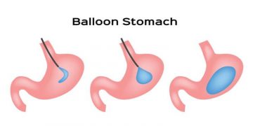Best Spatz3 Gastric Balloon Weight Loss Stories
