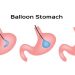 Best Spatz3 Gastric Balloon Weight Loss Stories