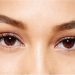 Can botox be used under the eyes?