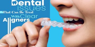Common Dental Issues That Can Be Treat With Clear Aligners