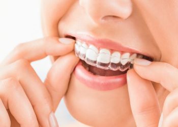 Why Should You Consider Using Invisalign?