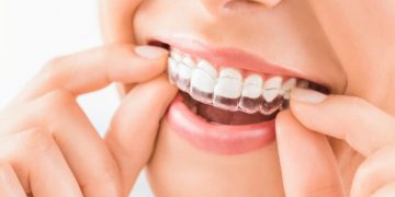 Why Should You Consider Using Invisalign?