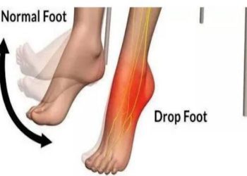 The Ultimate Guide to Choosing the Best FES Machine for Foot Drop