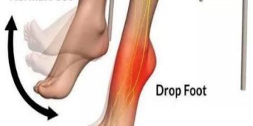 The Ultimate Guide to Choosing the Best FES Machine for Foot Drop