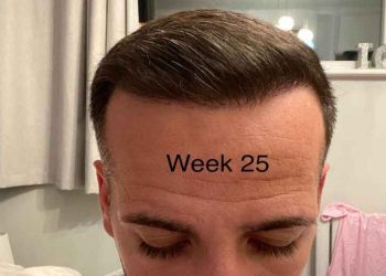 Before and After Hair Transplant Results in the UK