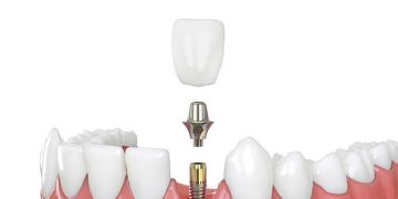 Types of Dental Implants: Which One is Right for You?