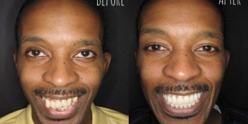 All-on-4 Dental Implants: Transform Your Smile Before and After
