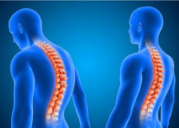 A Comprehensive Guide to Managing Kyphosis