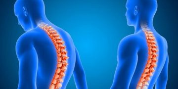 A Comprehensive Guide to Managing Kyphosis