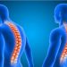 A Comprehensive Guide to Managing Kyphosis