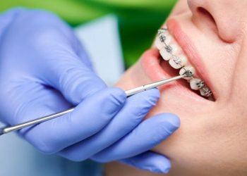 Braces and Beyond: Exploring Your Options for Orthodontic Treatment in Surrey